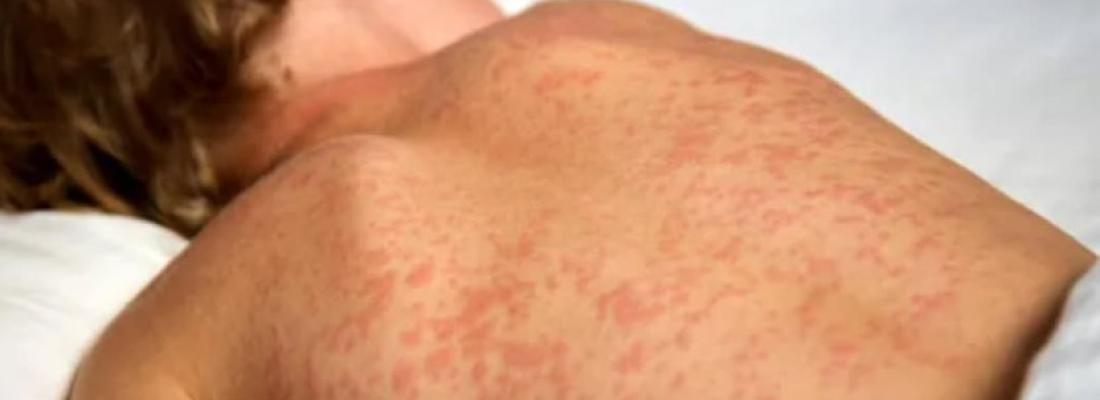 A child infected with measles. (Photo via Facebook.)