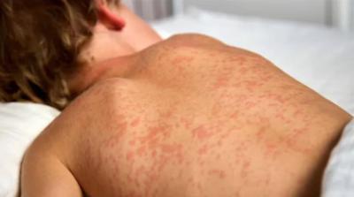 A child infected with measles. (Photo via Facebook.)