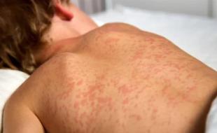 A child infected with measles. (Photo via Facebook.)